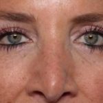 Blepharoplasty Before & After Patient #33674