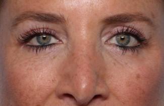 Blepharoplasty Before & After Patient #33674