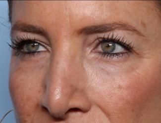 Blepharoplasty Before & After Patient #33674