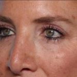 Blepharoplasty Before & After Patient #33674