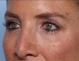 Blepharoplasty Before & After Patient #33674