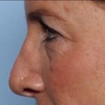 Blepharoplasty Before & After Patient #33674