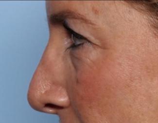 Blepharoplasty Before & After Patient #33674