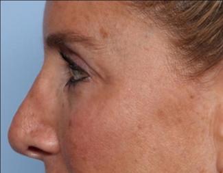 Blepharoplasty Before & After Patient #33674