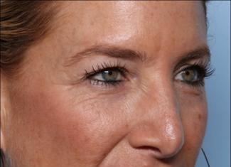 Blepharoplasty Before & After Patient #33674