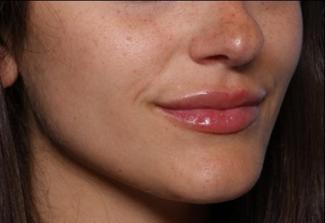 Lip Filler Before & After Patient #33685