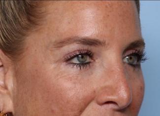 Blepharoplasty Before & After Patient #33674