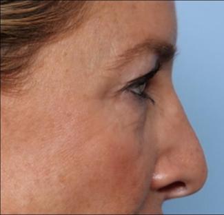 Blepharoplasty Before & After Patient #33674