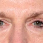 Blepharoplasty Before & After Patient #33840