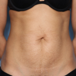 Tummy Tuck Before & After Patient #33772