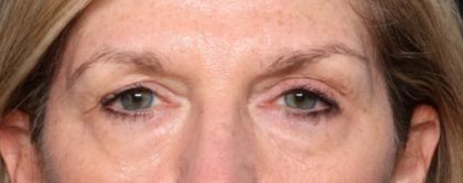 Blepharoplasty Before & After Patient #33840