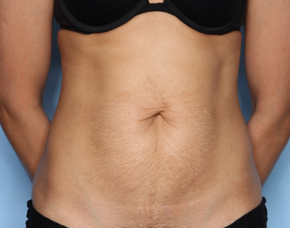 Tummy Tuck Before & After Patient #33772