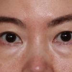 Blepharoplasty Before & After Patient #33739