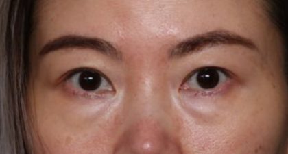 Blepharoplasty Before & After Patient #33739