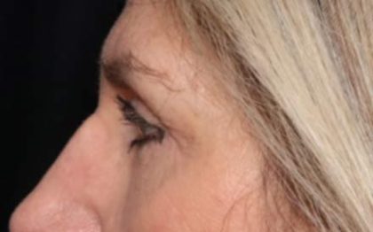 Blepharoplasty Before & After Patient #33840