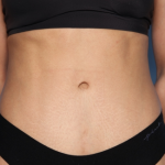 Tummy Tuck Before & After Patient #33772