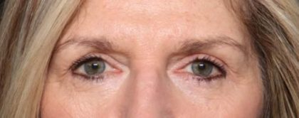 Blepharoplasty Before & After Patient #33840