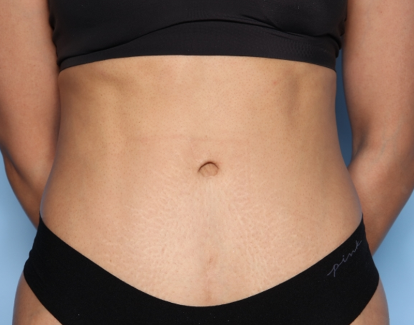 Tummy Tuck Before & After Patient #33772