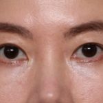 Blepharoplasty Before & After Patient #33739