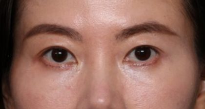 Blepharoplasty Before & After Patient #33739