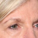 Blepharoplasty Before & After Patient #33840