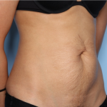 Tummy Tuck Before & After Patient #33772