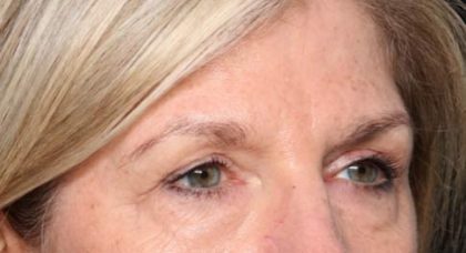 Blepharoplasty Before & After Patient #33840