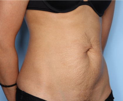 Tummy Tuck Before & After Patient #33772