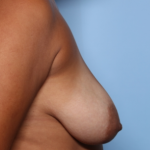 Breast Lift Before & After Patient #33816