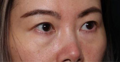 Blepharoplasty Before & After Patient #33739