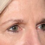 Blepharoplasty Before & After Patient #33840