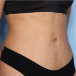 Tummy Tuck Before & After Patient #33772