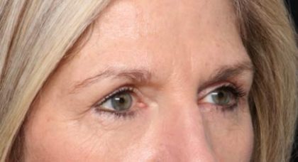 Blepharoplasty Before & After Patient #33840