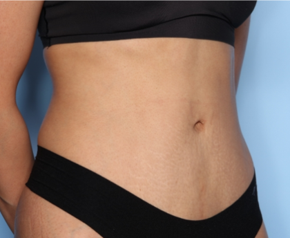 Tummy Tuck Before & After Patient #33772