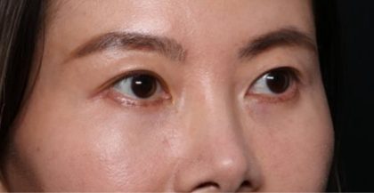 Blepharoplasty Before & After Patient #33739