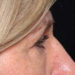Blepharoplasty Before & After Patient #33840