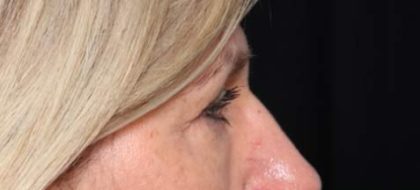 Blepharoplasty Before & After Patient #33840