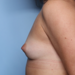 Breast Augmentation Before & After Patient #33761