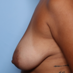 Breast Lift Before & After Patient #33816