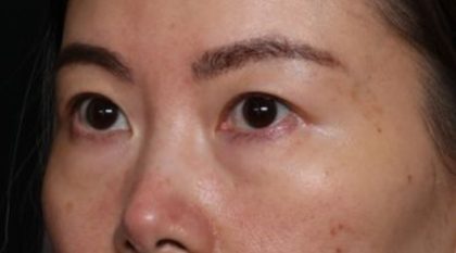 Blepharoplasty Before & After Patient #33739