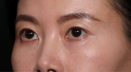 Blepharoplasty Before & After Patient #33739