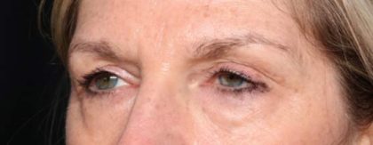 Blepharoplasty Before & After Patient #33840