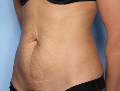 Tummy Tuck Before & After Patient #33772