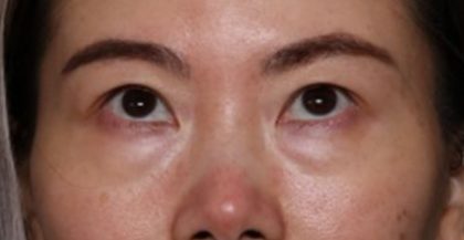 Blepharoplasty Before & After Patient #33739