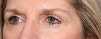 Blepharoplasty Before & After Patient #33840