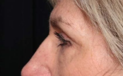 Blepharoplasty Before & After Patient #33840