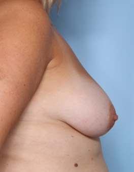 Breast Lift Before & After Patient #33906