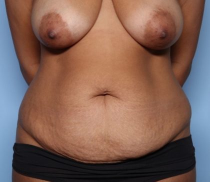Tummy Tuck Before & After Patient #33793