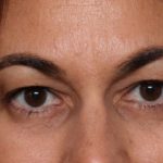 Blepharoplasty Before & After Patient #33829