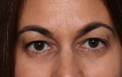 Blepharoplasty Before & After Patient #33829